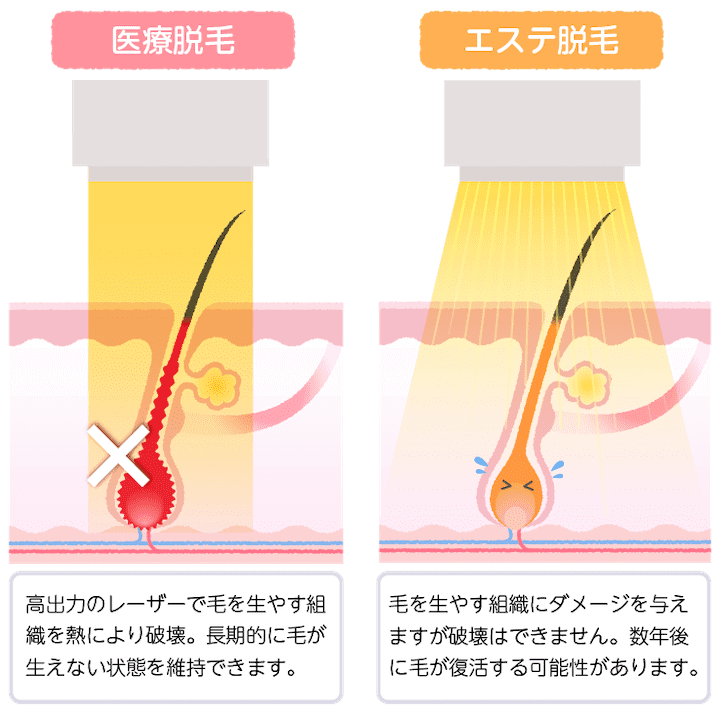 医療脱毛とエステ脱毛の違い